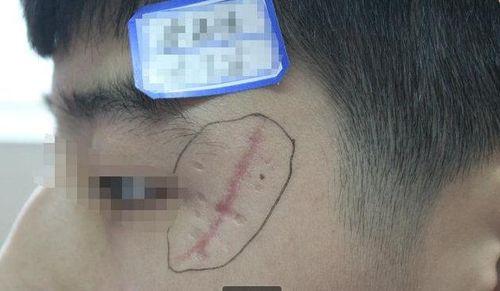 脸上伤疤图片,见证岁月的痕迹